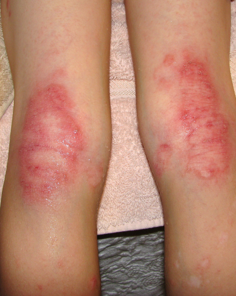 What is Eczema? Allergy & Rheumatology Specialists of Houston